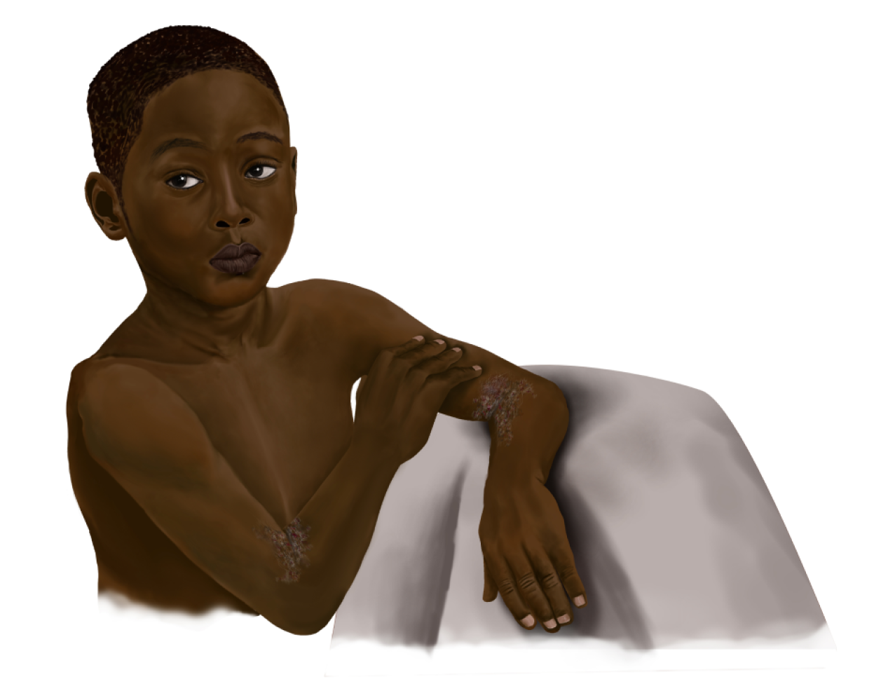 Pictures Of Atopic Dermatitis On Black Dark Skin Illustration Change pictures-of-atopic-dermatitis-on-black-dark-skin-illustration-change
